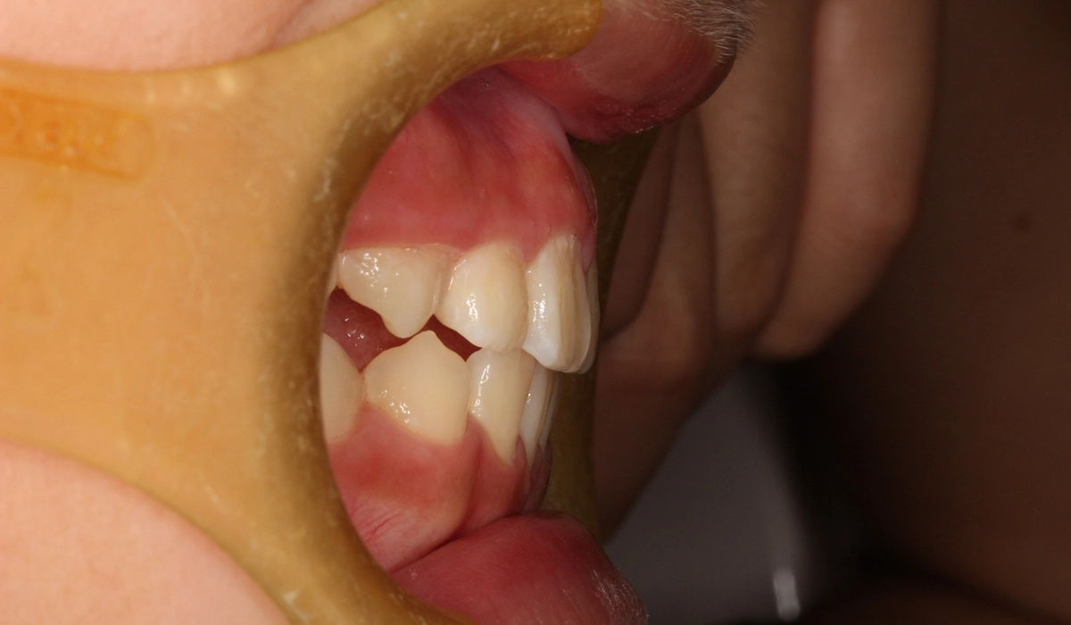 術後:オーバージェット