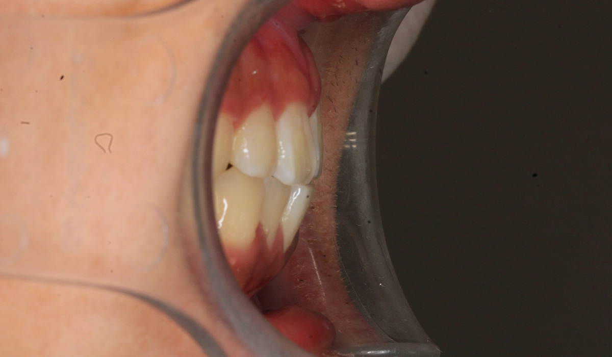 術後:オーバージェット