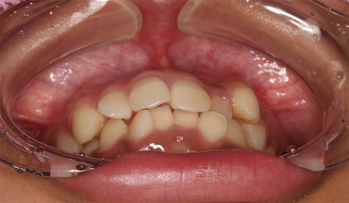 術前:前歯部あおり