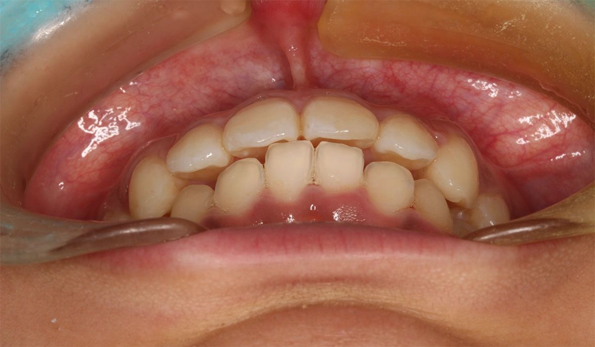 術後:前歯部あおり