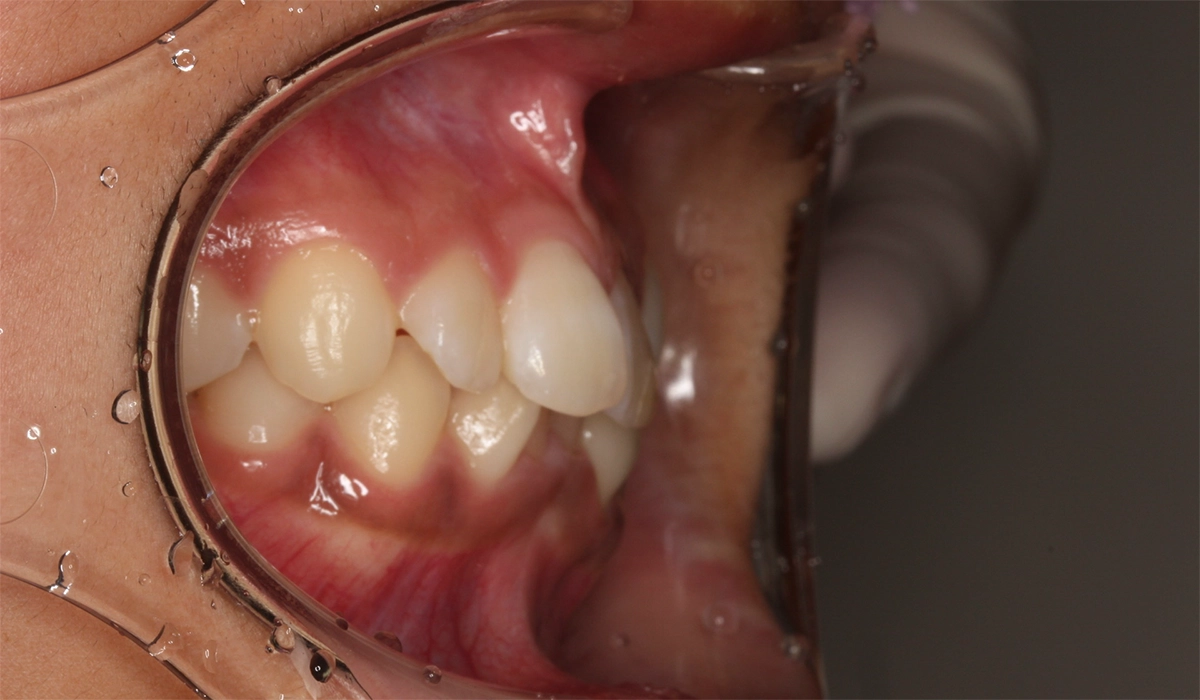 術後:オーバージェット