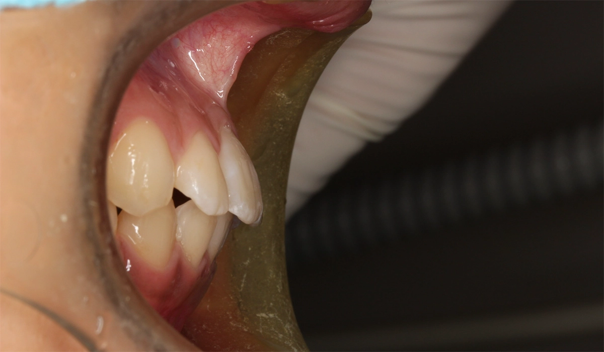 術前:オーバージェット