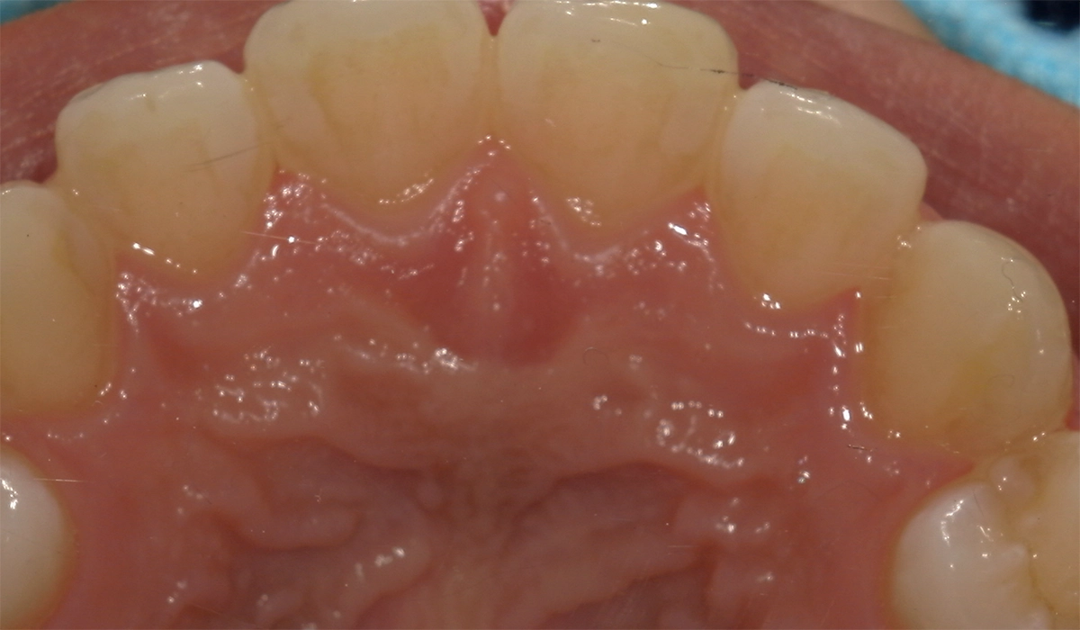 術前:上前歯部寄り