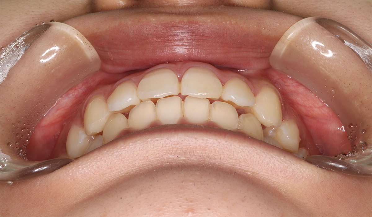 術後:前歯部あおり