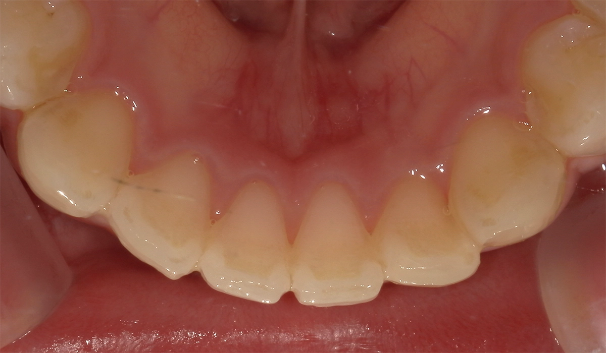 術前:下前歯部寄り