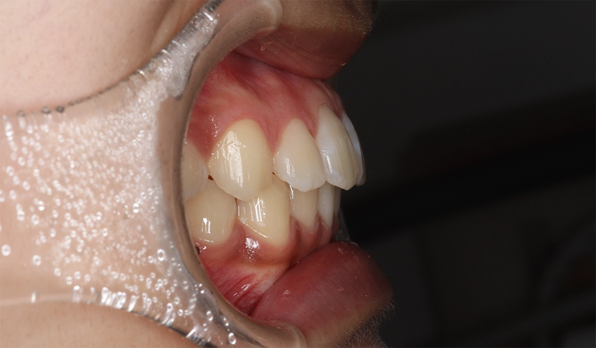 術後:オーバージェット