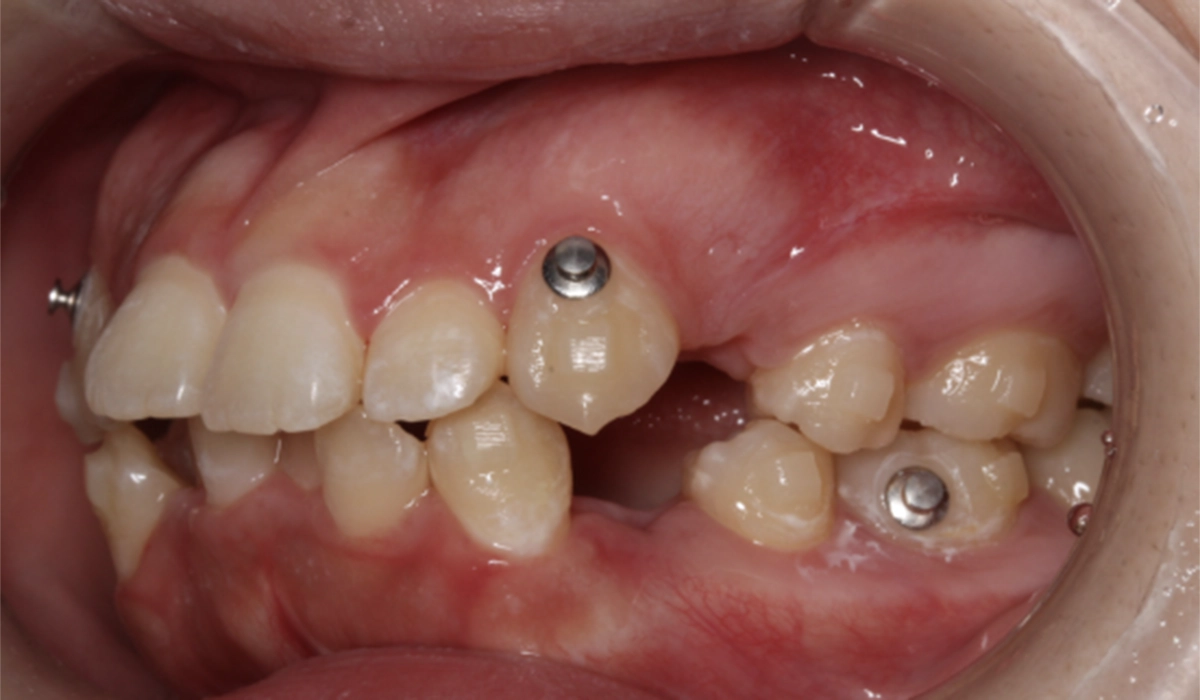 抜歯をしての治療