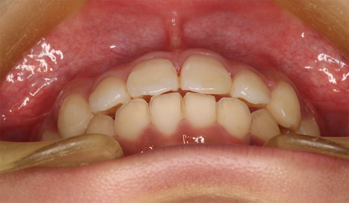 術後:前歯部あおり