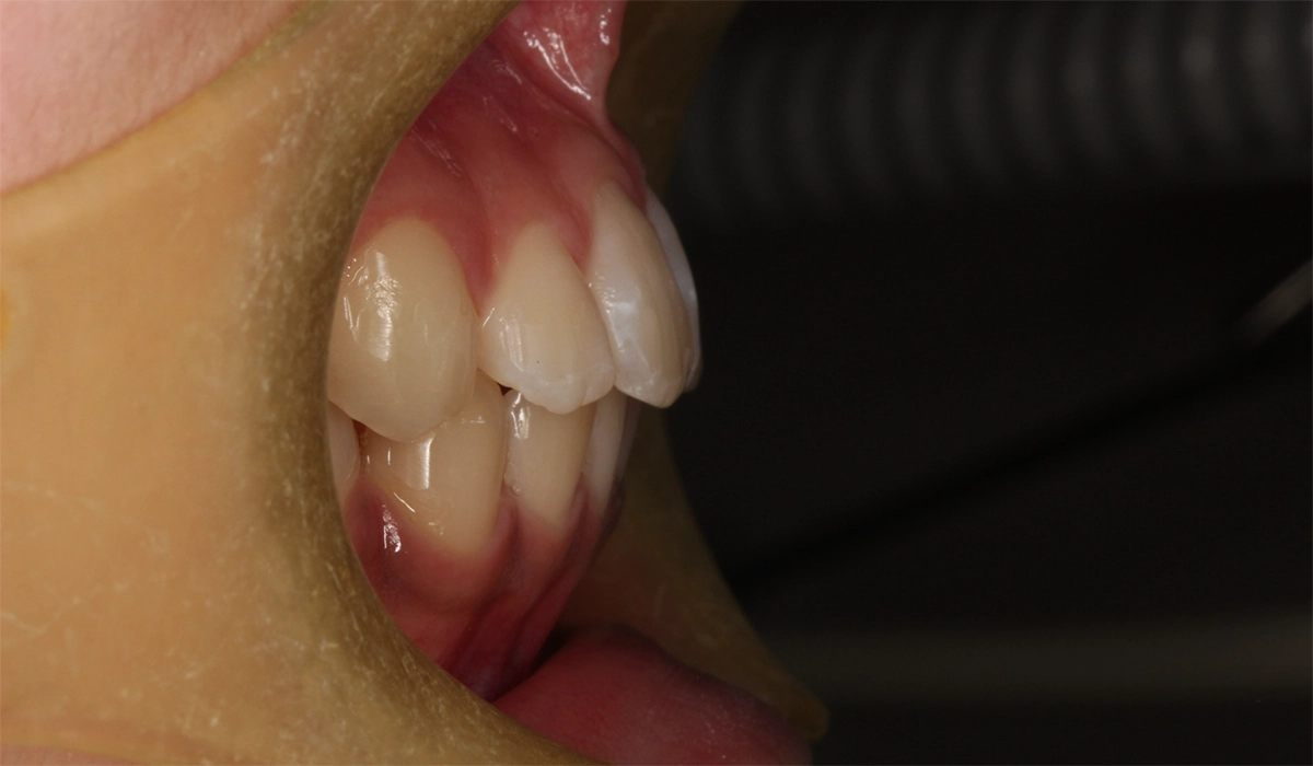 術後:オーバージェット