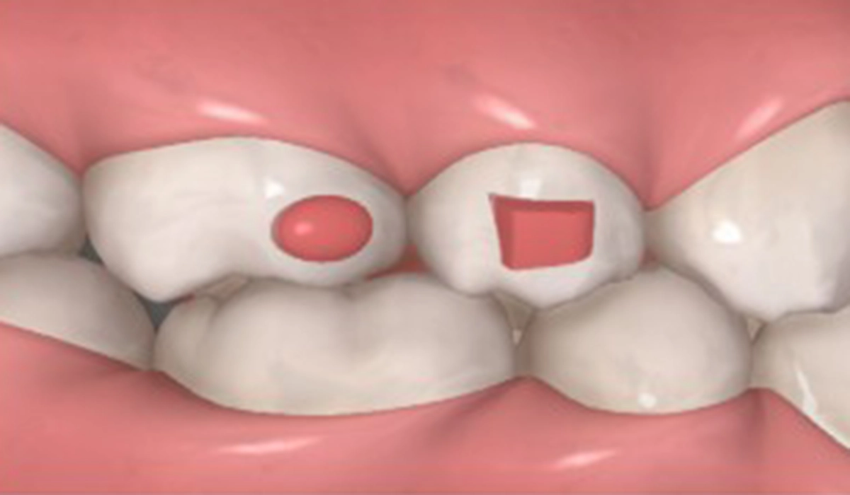 通常アタッチメント