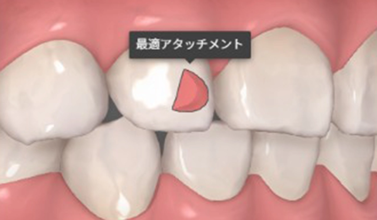 最適アタッチメント