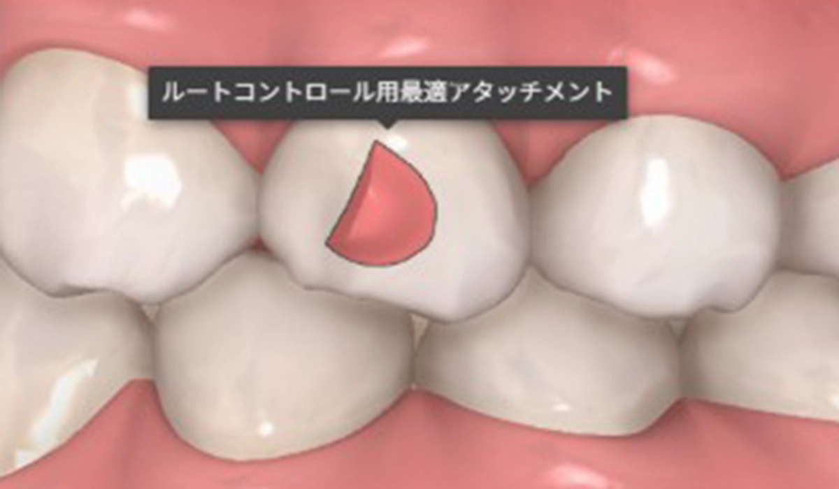 ルートコントロール用最適アタッチメント