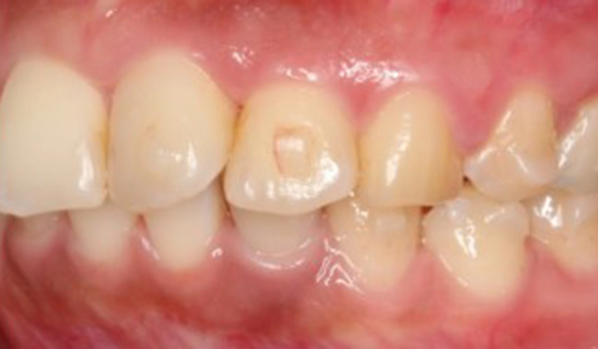 インビザラインのアタッチメントで起こるトラブル