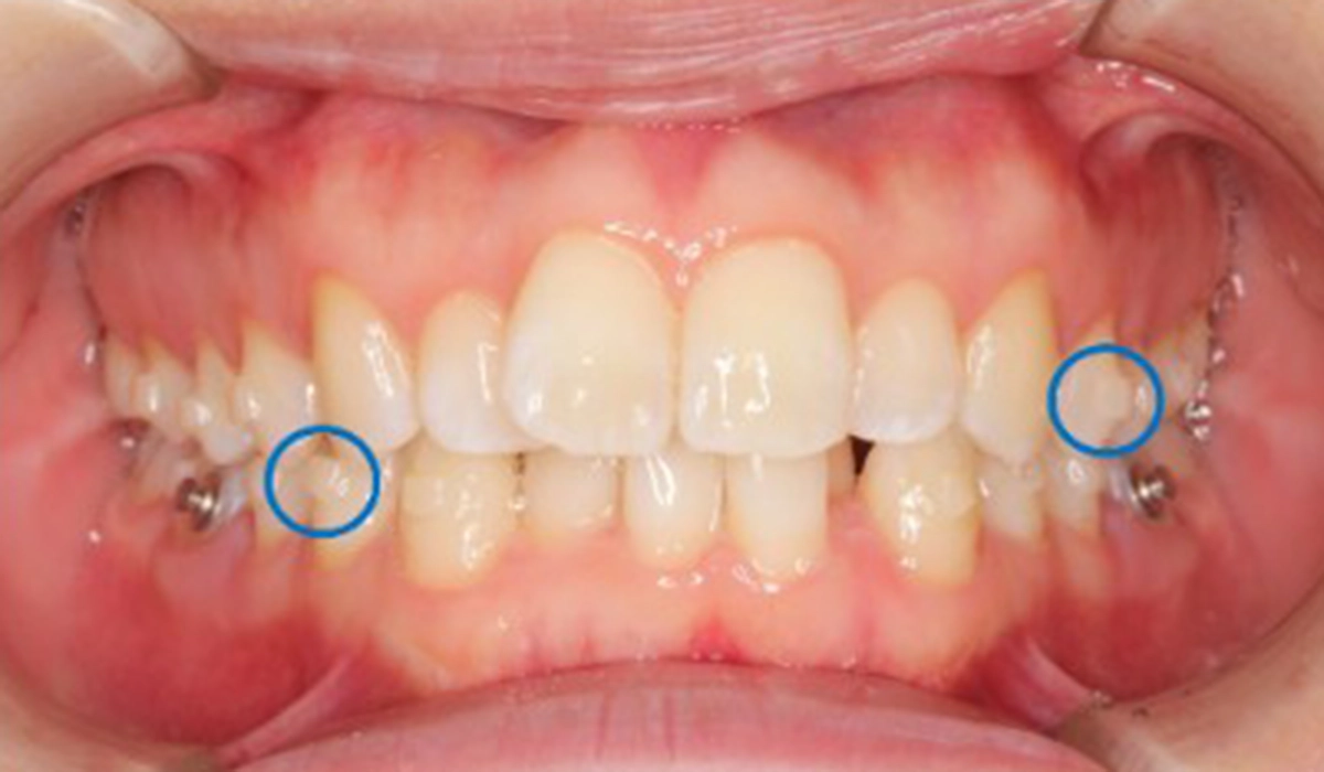 インビザラインのアタッチメントとは?