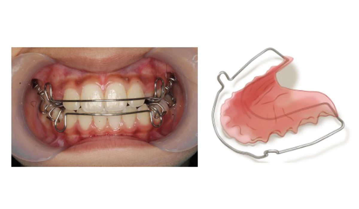 プレートタイプ（取り外し式）