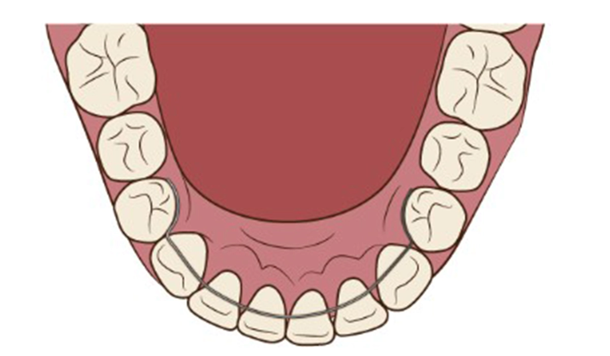 フィックスタイプ（固定式）