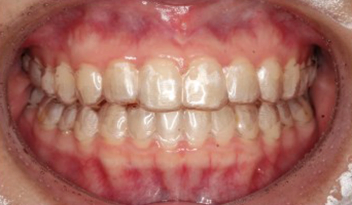 マウスピースタイプ（取り外し式）