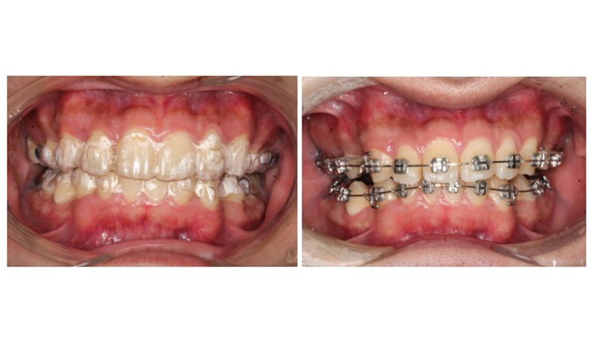 ワイヤー矯正よりもインビザは目立ちにくい