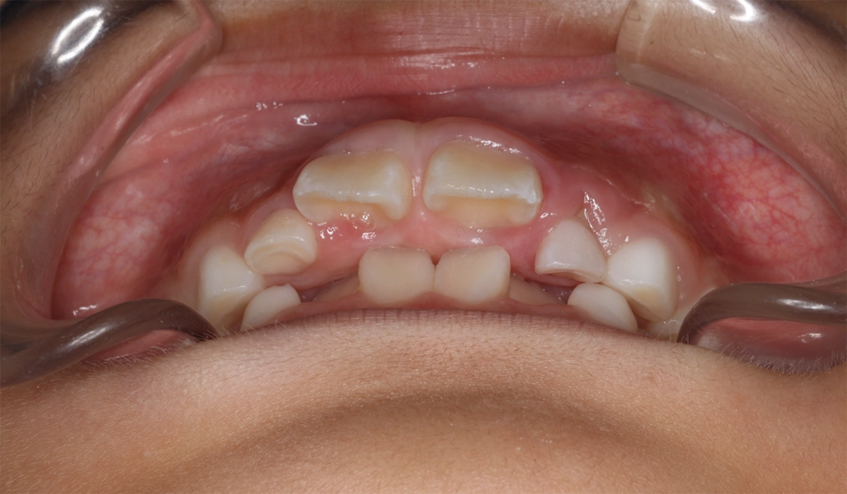 術前:前歯部あおり