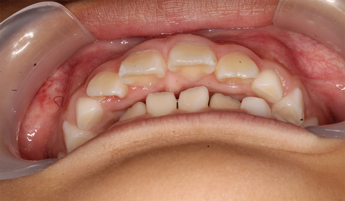 術後:前歯部あおり