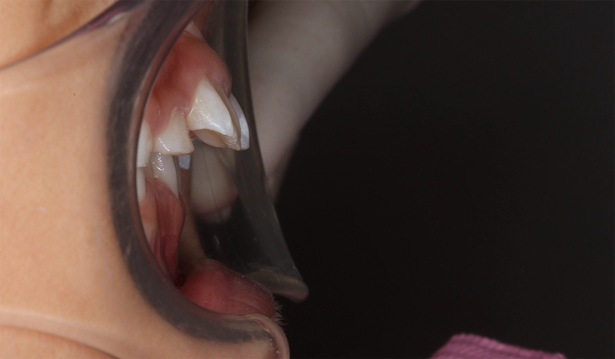 術前:オーバージェット