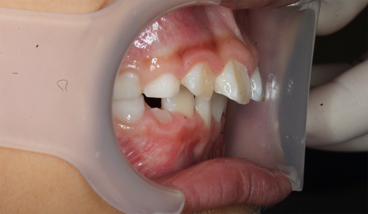 術後:オーバージェット