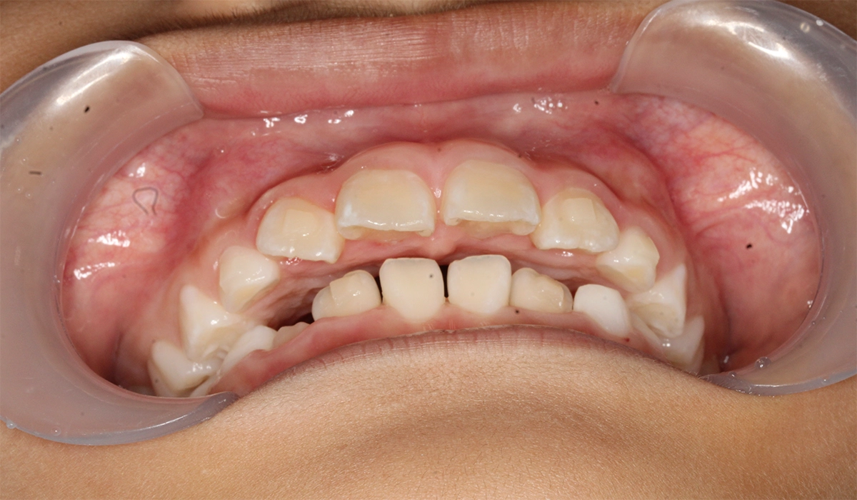 術前:前歯部あおり