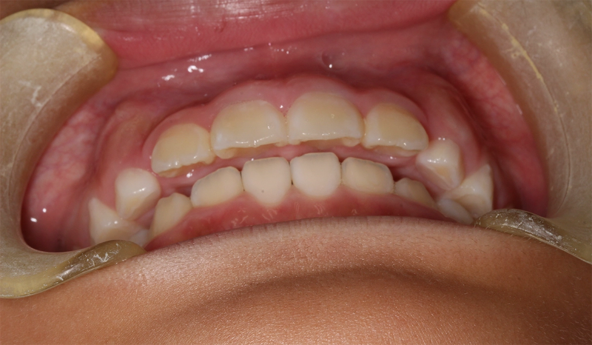 術後:前歯部あおり