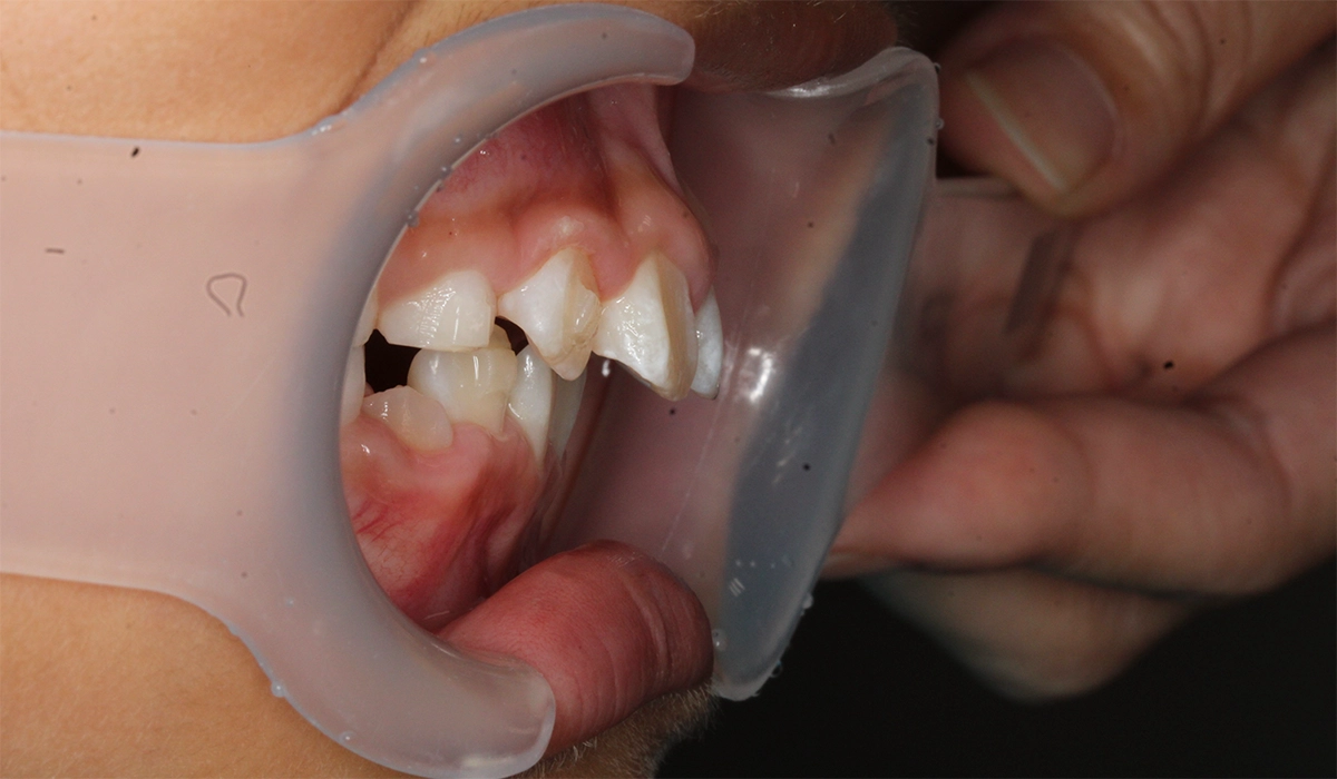 術前:オーバージェット