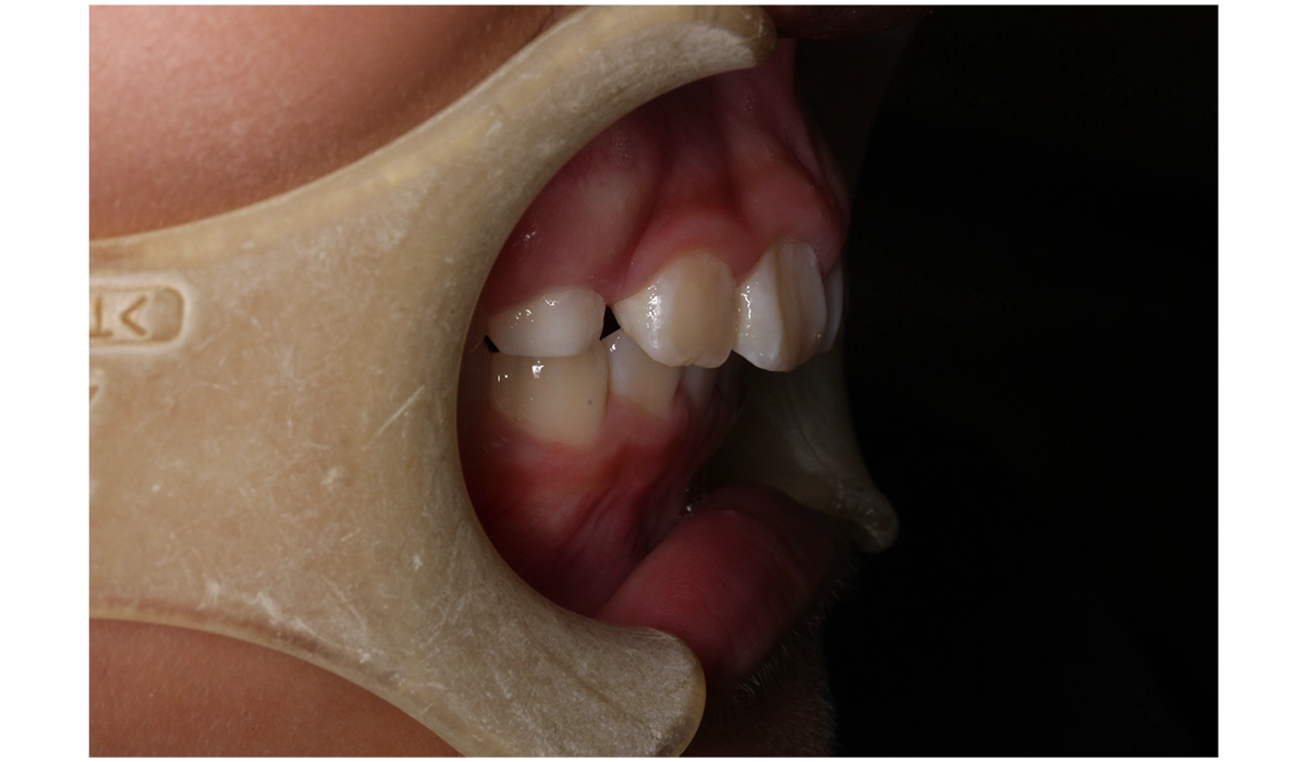 術後:オーバージェット