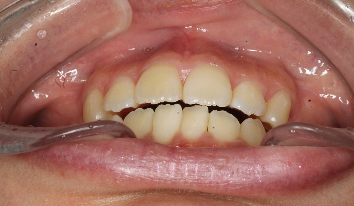 術前:前歯部あおり