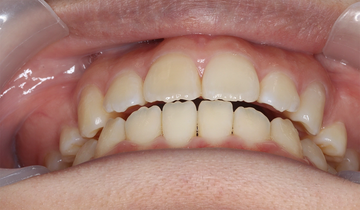 術後:前歯部あおり