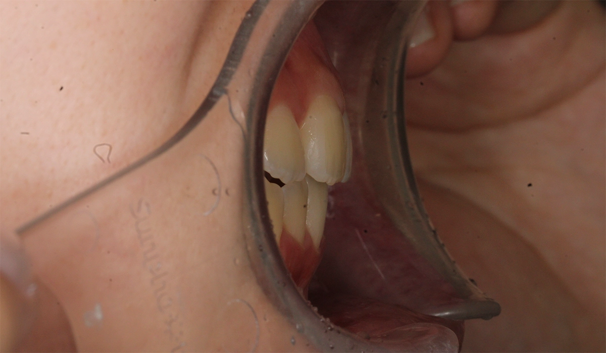 術前:オーバージェット