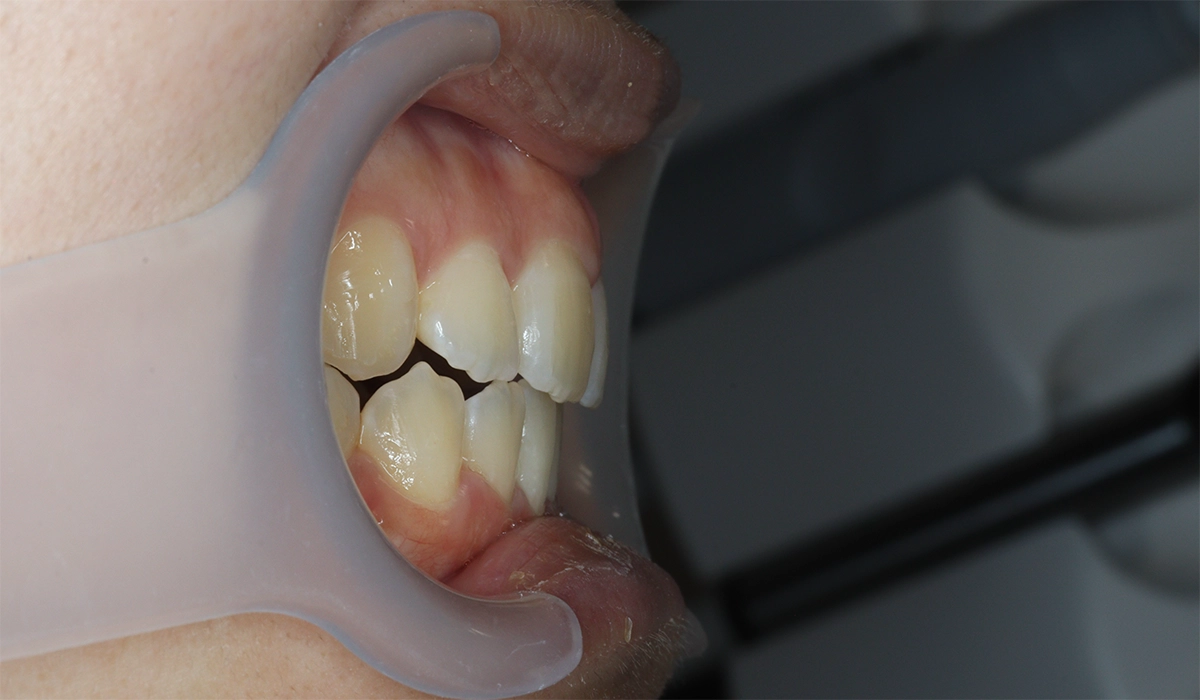 術後:オーバージェット