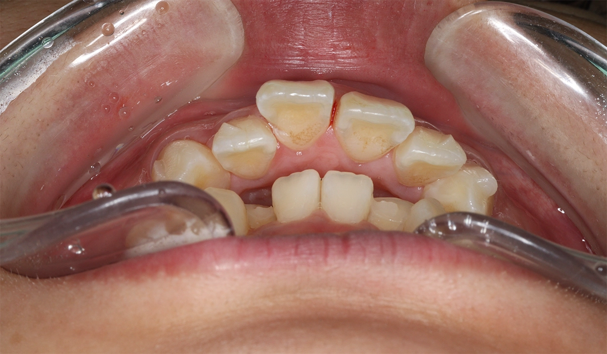 術前:前歯部あおり