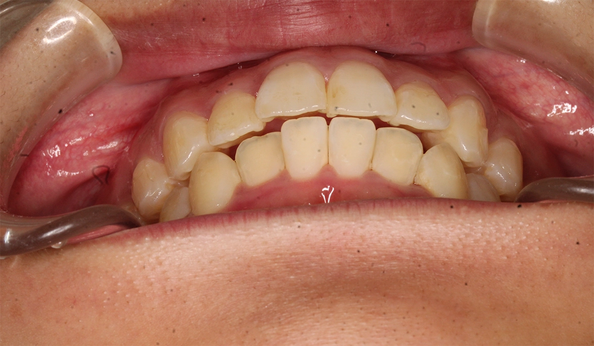 術後:前歯部あおり