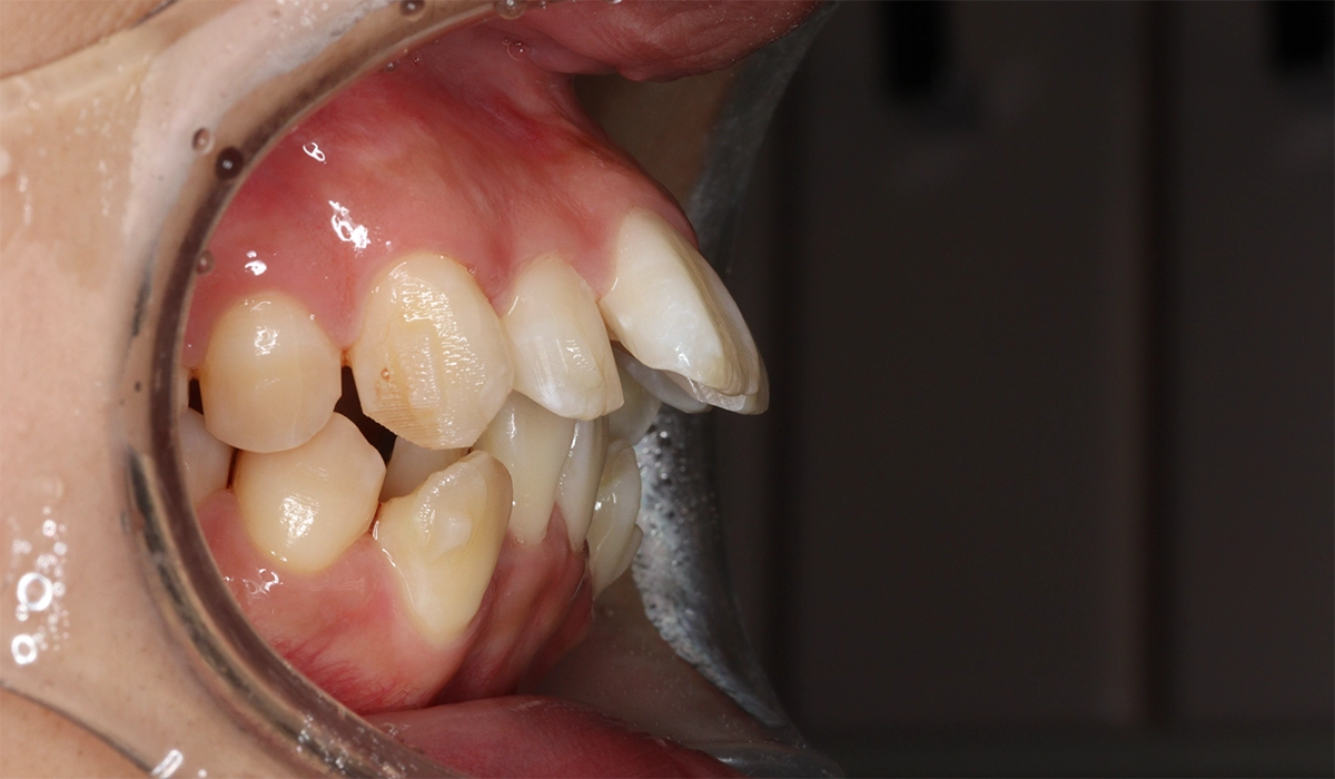 術前:オーバージェット