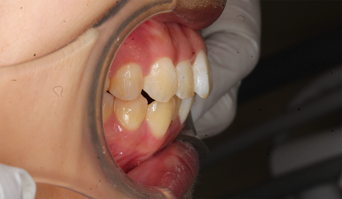 術後:オーバージェット